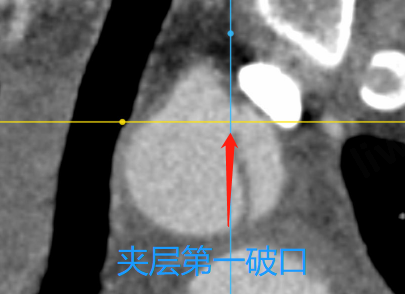 动脉长鞘怎么置入【弓部重建直通车】真腔难觅，另辟蹊径｜潍坊市人民医院血管外科运用Castor®支架结合长鞘建立导丝通路治疗主动脉夹层两例_https://www.jmylbn.com_新闻资讯_第14张