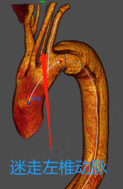 动脉长鞘怎么置入【弓部重建直通车】真腔难觅，另辟蹊径｜潍坊市人民医院血管外科运用Castor®支架结合长鞘建立导丝通路治疗主动脉夹层两例_https://www.jmylbn.com_新闻资讯_第7张
