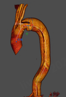 动脉长鞘怎么置入【弓部重建直通车】真腔难觅，另辟蹊径｜潍坊市人民医院血管外科运用Castor®支架结合长鞘建立导丝通路治疗主动脉夹层两例_https://www.jmylbn.com_新闻资讯_第6张