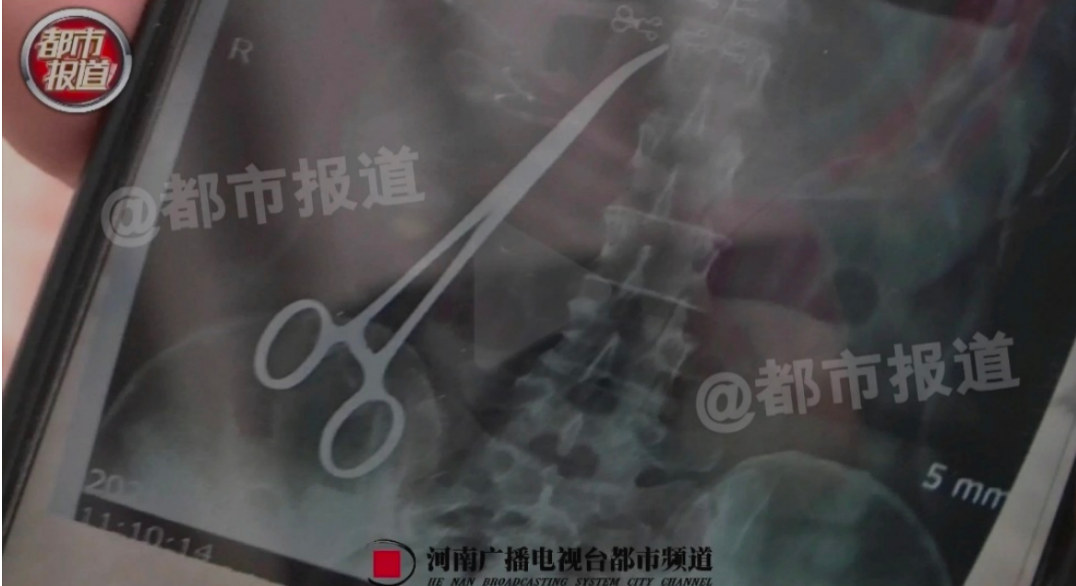 手术钳怎么拿产妇术后遗留15cm止血钳，15个月后才被取出！_https://www.jmylbn.com_新闻资讯_第1张