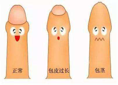 包皮吻合器是什么一次性包皮环切吻合器的临床应用_https://www.jmylbn.com_新闻资讯_第1张