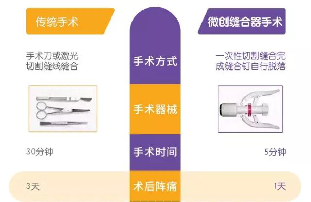 包皮吻合器是什么一次性包皮环切吻合器的临床应用_https://www.jmylbn.com_新闻资讯_第4张