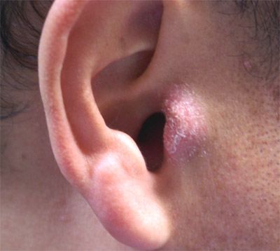 主要症状为瘙痒,皮肤可出现弥漫性潮红,丘疹,水泡,渗液,结痂水泡破溃