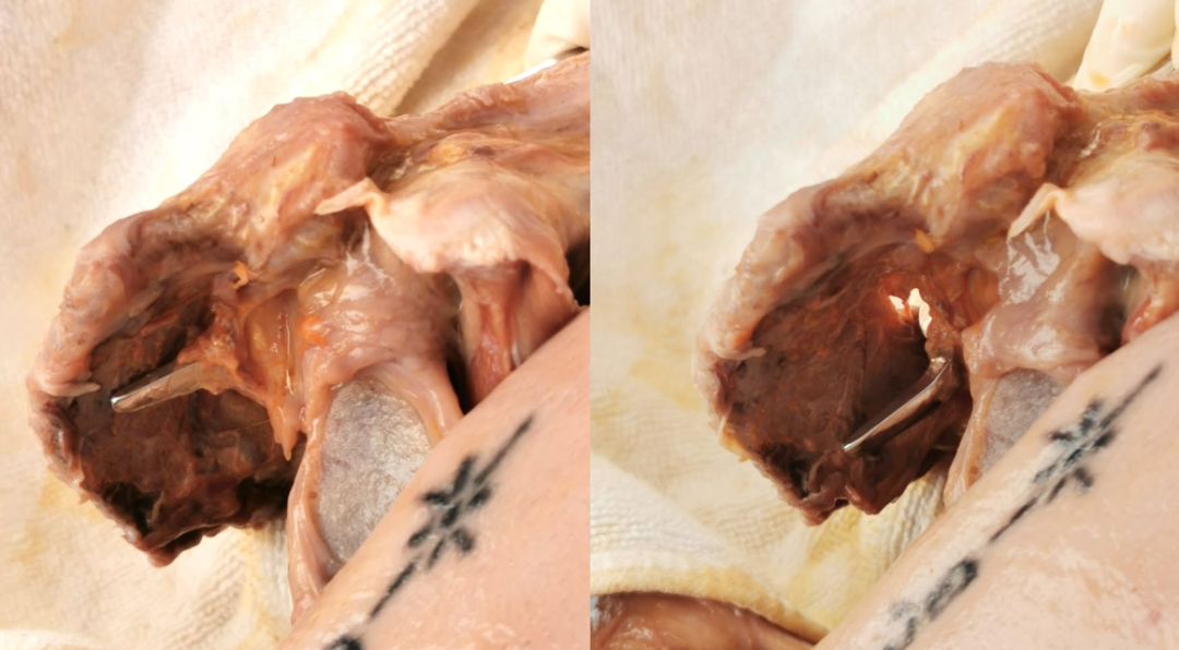 锁骨钩钢板怎么放？偏前