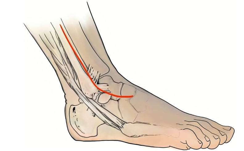 复杂Pilon骨折：“四原则”与“四步定基法”