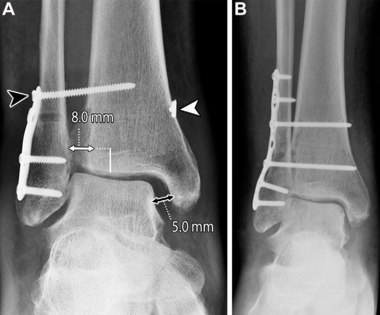 下胫腓联合损伤最全攻略｜解剖、生物力学、影像检查与术后评估