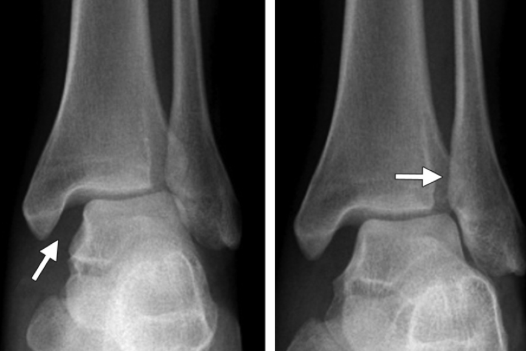 下胫腓联合损伤最全攻略｜解剖、生物力学、影像检查与术后评估