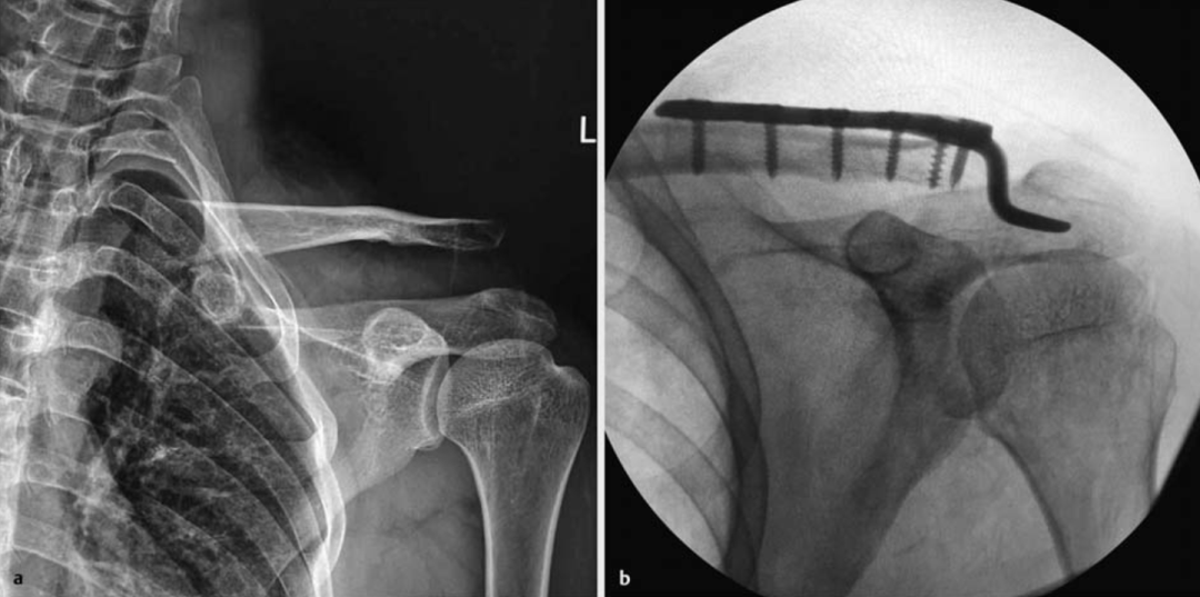 锁骨钩钢板怎么放？偏前