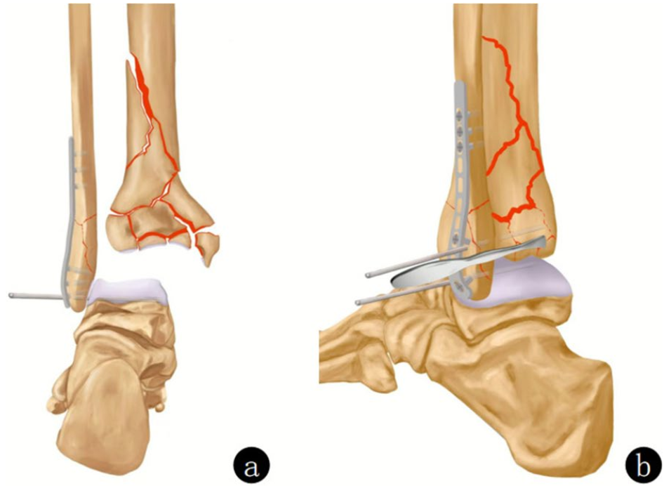 复杂Pilon骨折：“四原则”与“四步定基法”