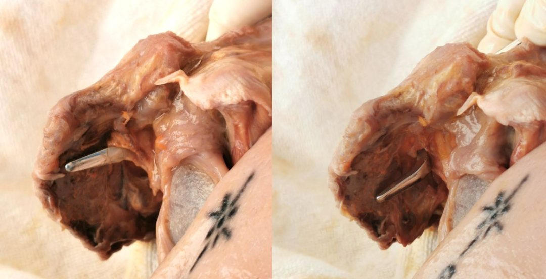 锁骨钩钢板怎么放？偏前