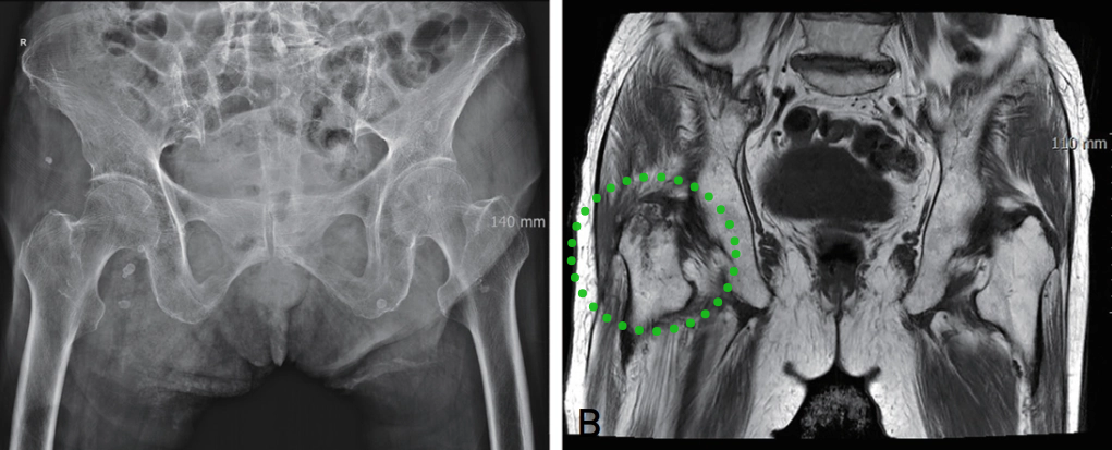 为什么需要警惕“孤立性股骨大转子骨折”？
