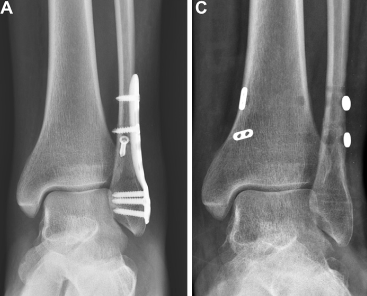 下胫腓联合损伤最全攻略｜解剖、生物力学、影像检查与术后评估