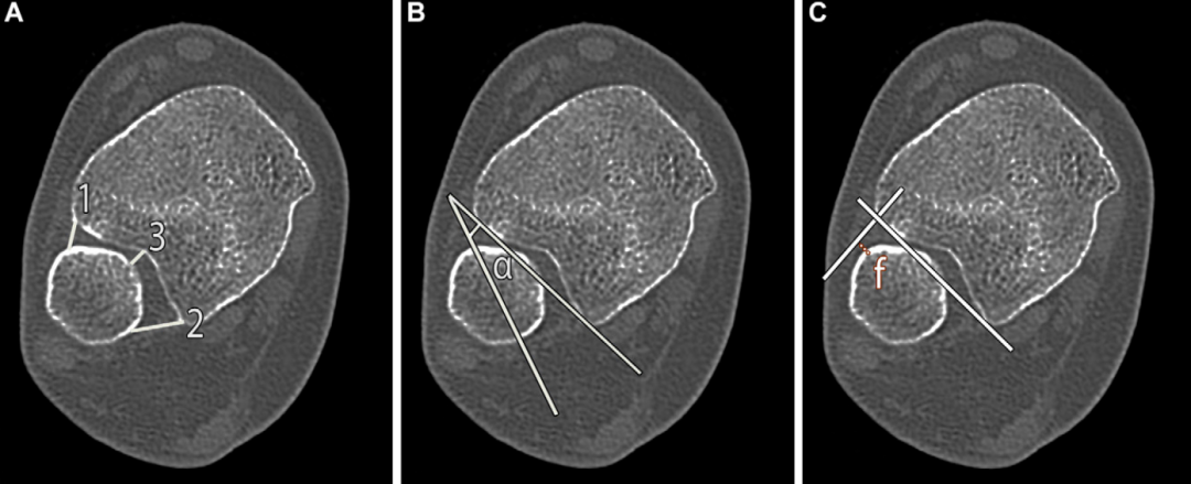 下胫腓联合损伤最全攻略｜解剖、生物力学、影像检查与术后评估