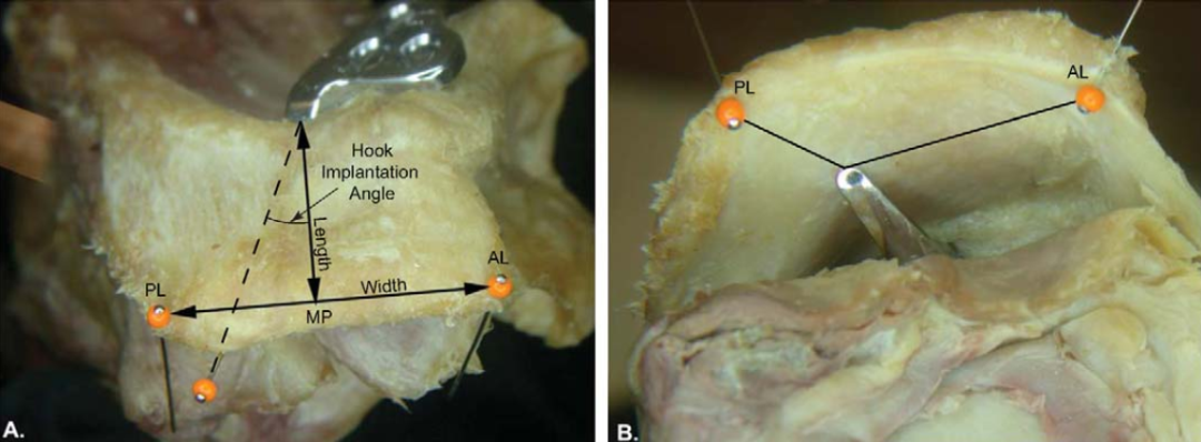 锁骨钩钢板怎么放？偏前