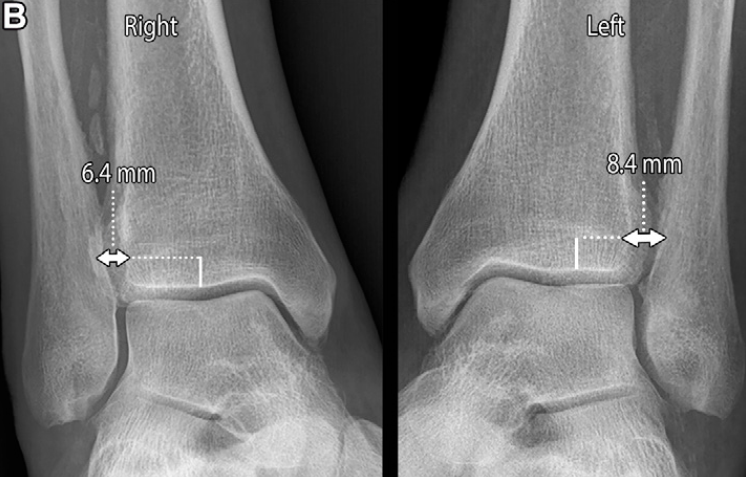 下胫腓联合损伤最全攻略｜解剖、生物力学、影像检查与术后评估