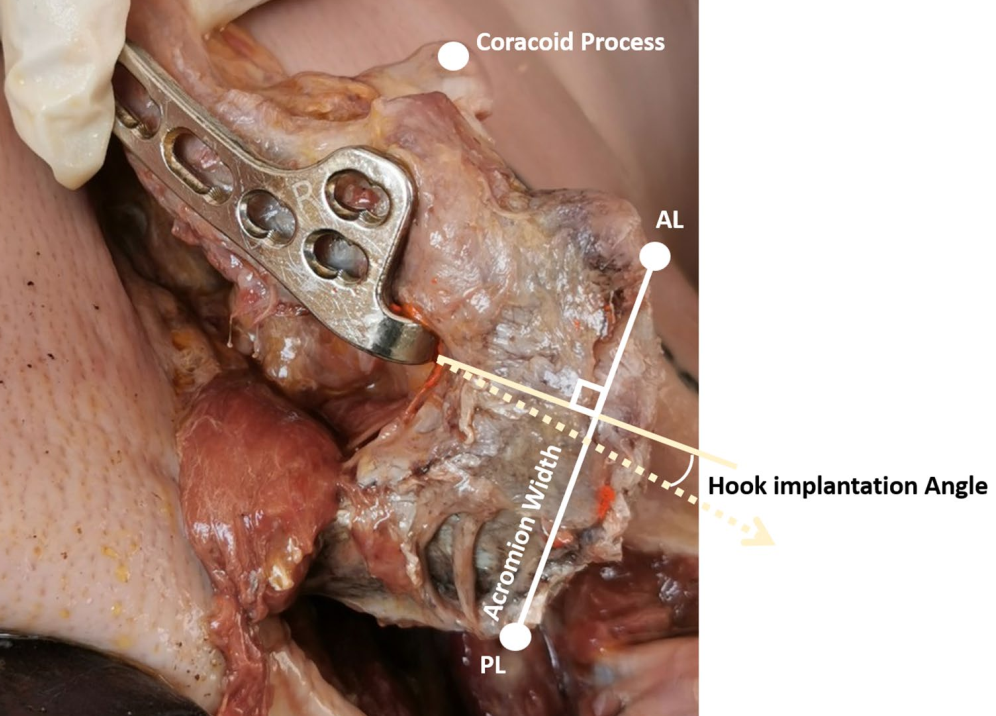 锁骨钩钢板怎么放？偏前