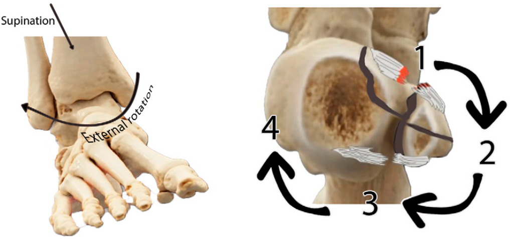 下胫腓联合损伤最全攻略｜解剖、生物力学、影像检查与术后评估