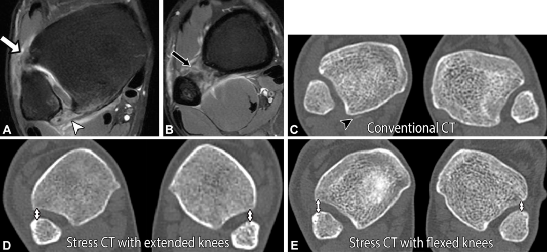 下胫腓联合损伤最全攻略｜解剖、生物力学、影像检查与术后评估