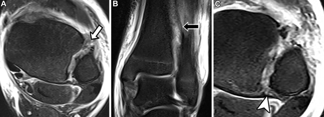 下胫腓联合损伤最全攻略｜解剖、生物力学、影像检查与术后评估