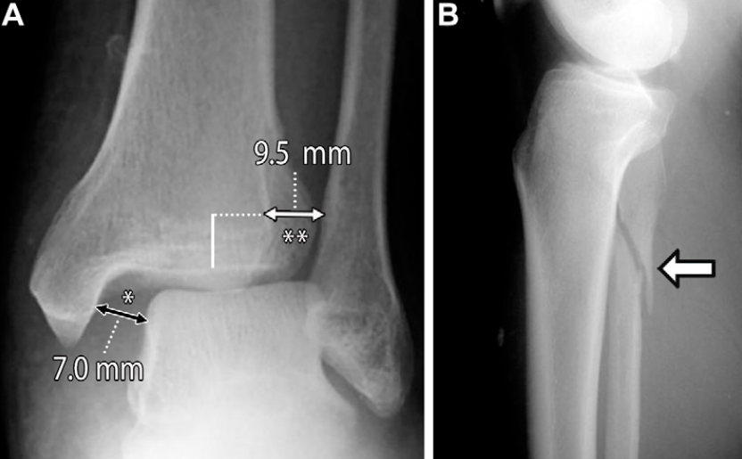 下胫腓联合损伤最全攻略｜解剖、生物力学、影像检查与术后评估