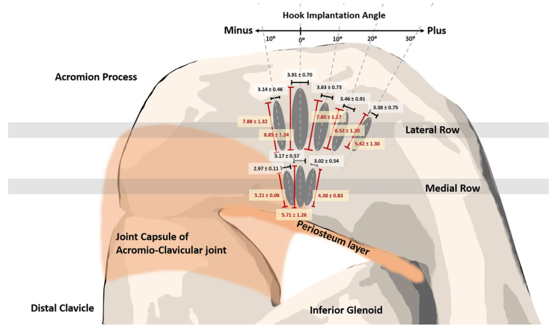 锁骨钩钢板怎么放？偏前