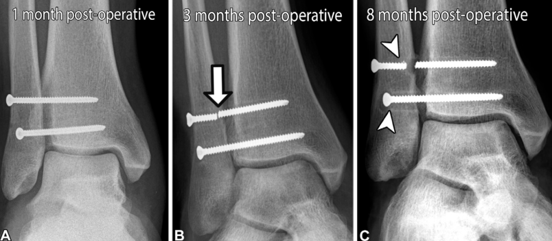 下胫腓联合损伤最全攻略｜解剖、生物力学、影像检查与术后评估