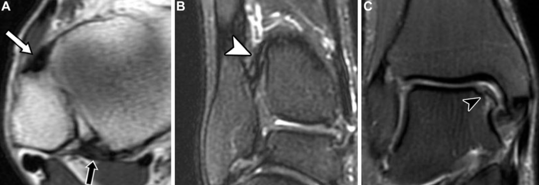 下胫腓联合损伤最全攻略｜解剖、生物力学、影像检查与术后评估