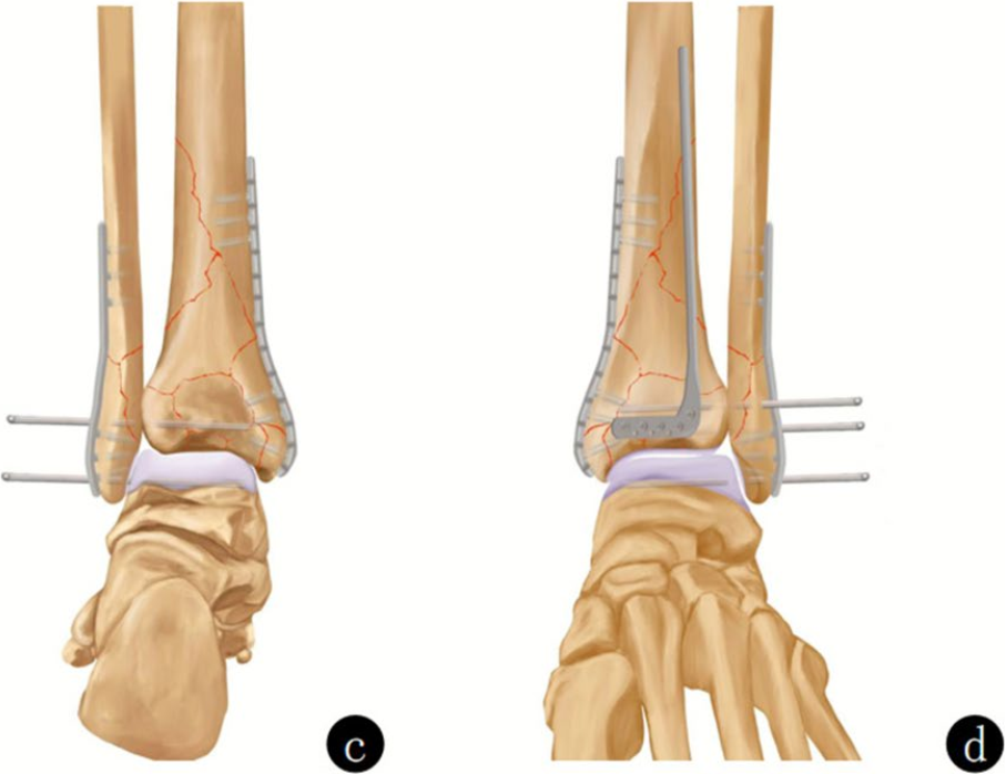 复杂Pilon骨折：“四原则”与“四步定基法”