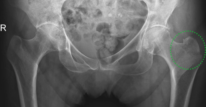 为什么需要警惕“孤立性股骨大转子骨折”？