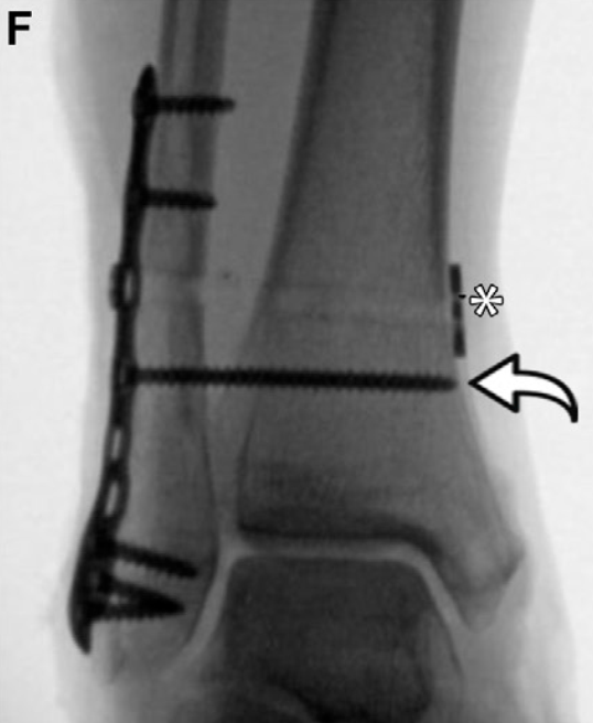 下胫腓联合损伤最全攻略｜解剖、生物力学、影像检查与术后评估