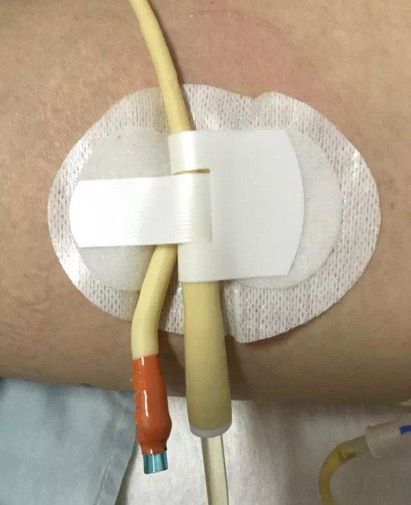 怎么固定引流管常见导管固定，T型、I型、Y型法用起来！_https://www.jmylbn.com_新闻资讯_第9张