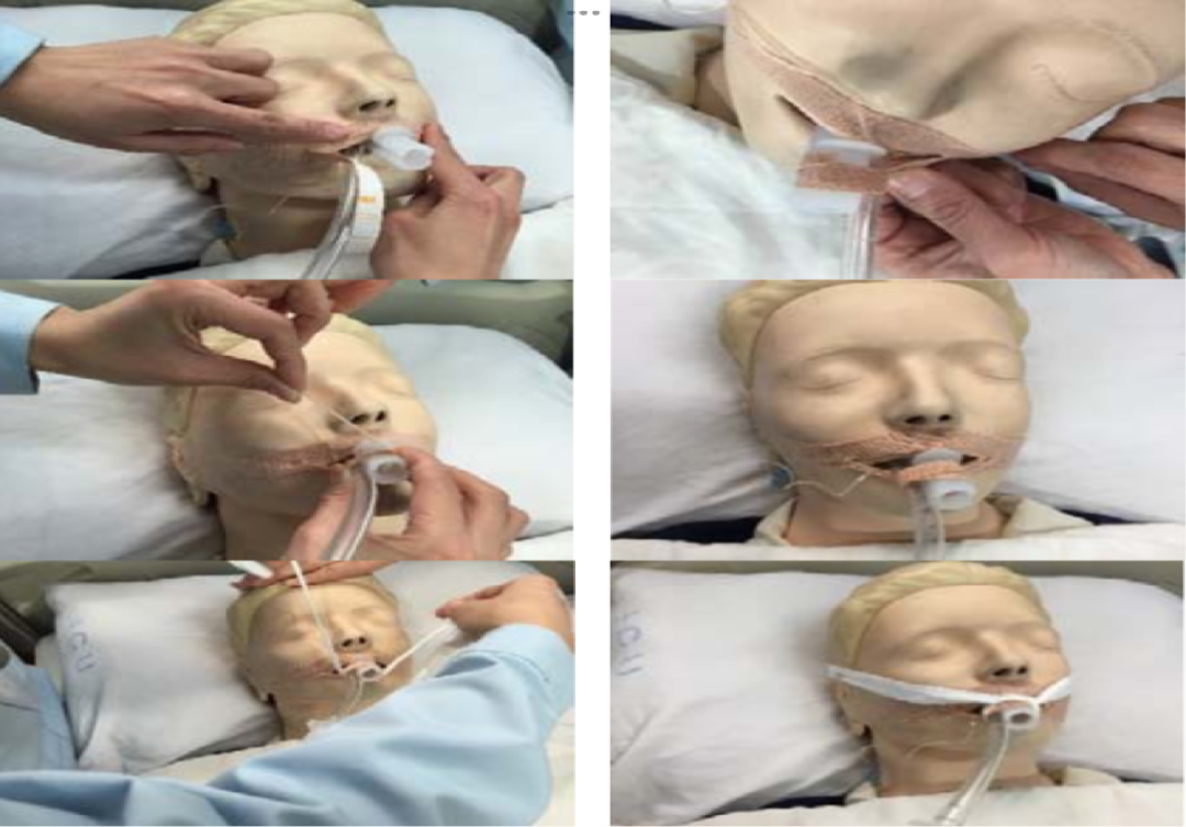 怎么固定引流管常见导管固定，T型、I型、Y型法用起来！_https://www.jmylbn.com_新闻资讯_第6张