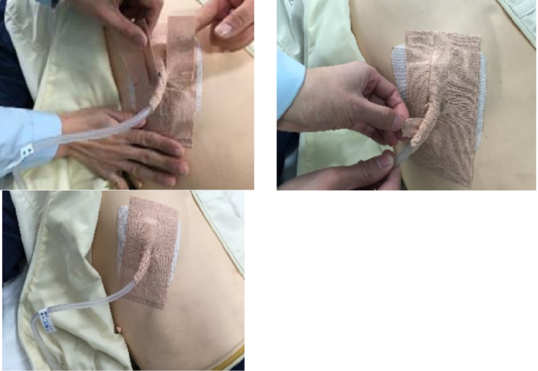 怎么固定引流管常见导管固定，T型、I型、Y型法用起来！_https://www.jmylbn.com_新闻资讯_第13张