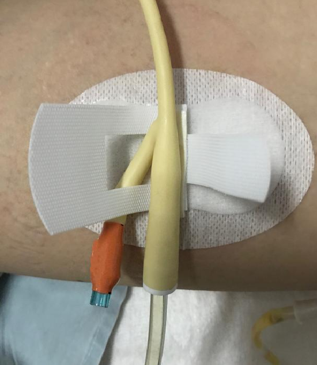 怎么固定引流管常见导管固定，T型、I型、Y型法用起来！_https://www.jmylbn.com_新闻资讯_第8张