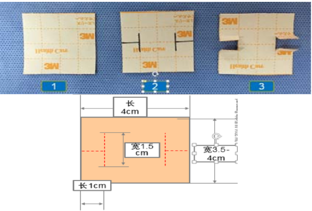 怎么固定引流管常见导管固定，T型、I型、Y型法用起来！_https://www.jmylbn.com_新闻资讯_第2张