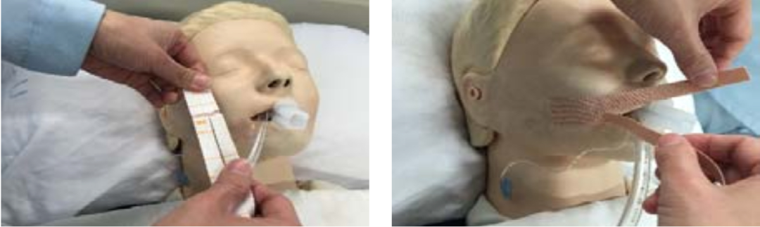 尿管怎么固定常见导管固定，T型、I型、Y型法_https://www.jmylbn.com_新闻资讯_第8张