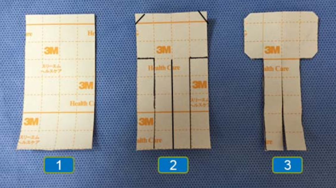 怎么固定引流管常见导管固定，T型、I型、Y型法用起来！_https://www.jmylbn.com_新闻资讯_第1张