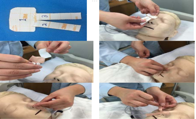 尿管怎么固定常见导管固定，T型、I型、Y型法_https://www.jmylbn.com_新闻资讯_第6张