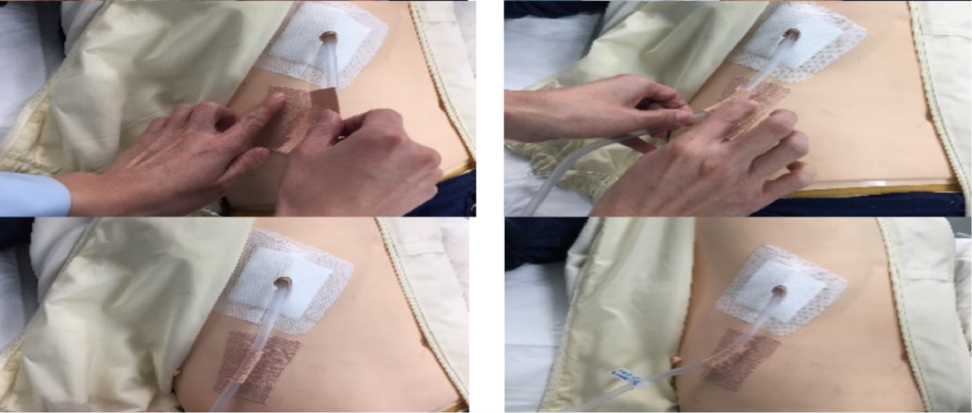 尿管怎么固定常见导管固定，T型、I型、Y型法_https://www.jmylbn.com_新闻资讯_第12张