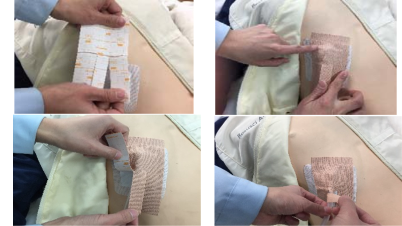 怎么固定引流管常见导管固定，T型、I型、Y型法用起来！_https://www.jmylbn.com_新闻资讯_第12张