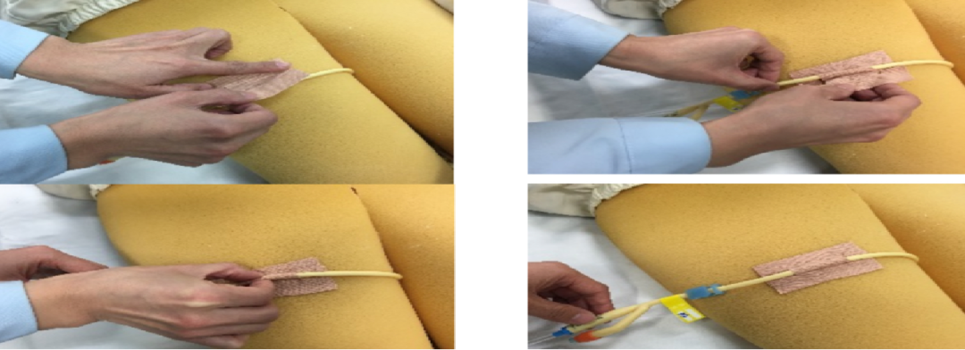 尿管怎么固定常见导管固定，T型、I型、Y型法_https://www.jmylbn.com_新闻资讯_第10张