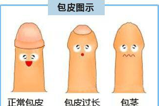 手术吻合器什么我院整形外科私密手术之包皮吻合器环切科普_https://www.jmylbn.com_新闻资讯_第1张