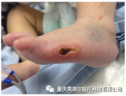 为什么手术用电刀2例手术电外科烧伤，生疼！哪个环节出了错？_https://www.jmylbn.com_新闻资讯_第2张