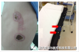 为什么手术用电刀2例手术电外科烧伤，生疼！哪个环节出了错？_https://www.jmylbn.com_新闻资讯_第3张