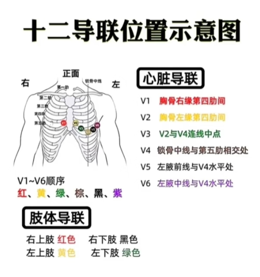 十二道心电图怎么检查胸痛心慌查心电图？12导联or18导联，医生教您精准选_https://www.jmylbn.com_新闻资讯_第4张