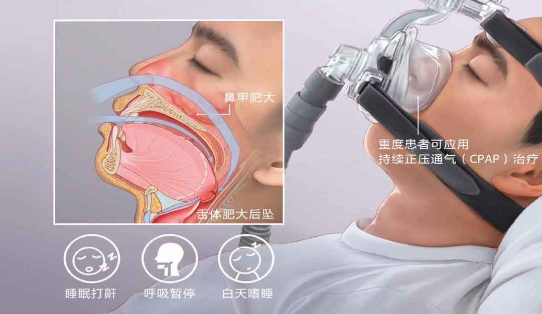 什么是睡眠呼吸机奥运冠军自曝需终身佩戴呼吸机？睡眠医学专家：原来是此病惹“祸”！_https://www.jmylbn.com_新闻资讯_第4张