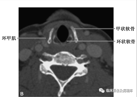 声门CT图片