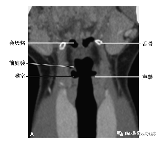 声门CT图片