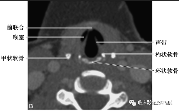 喉部ct解剖ppt图片