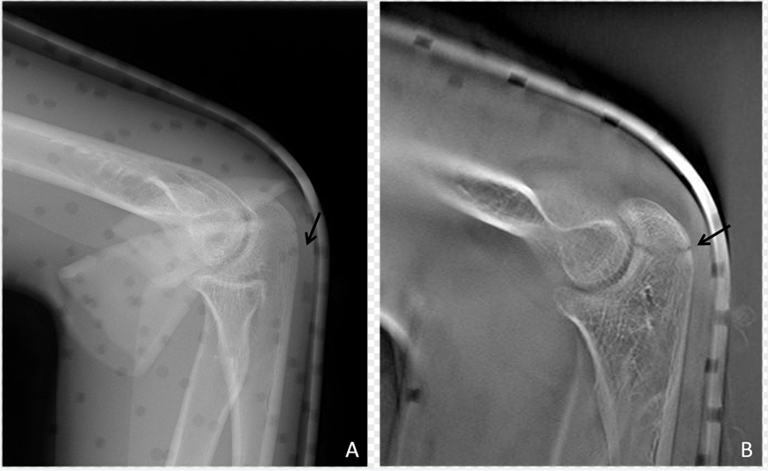 dr数字怎么用数字化X线摄影术（DR）_https://www.jmylbn.com_新闻资讯_第5张